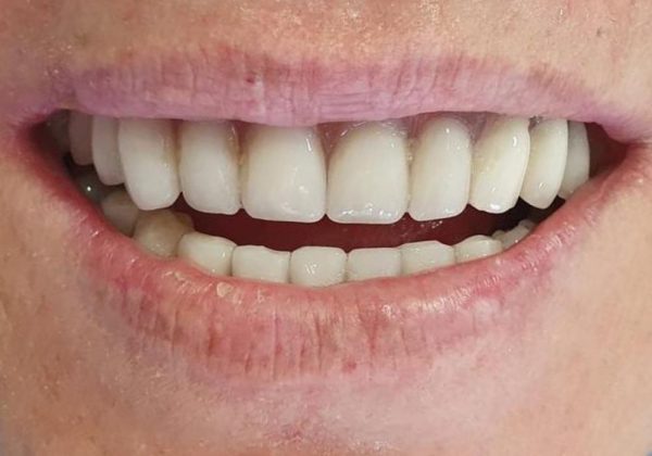 Después: prótesis fija completa, con las piezas alineadas y del mismo color