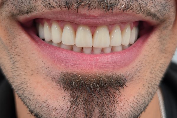 Después: prótesis fija completa sobre implantes, con las piezas alineadas y la encía sana