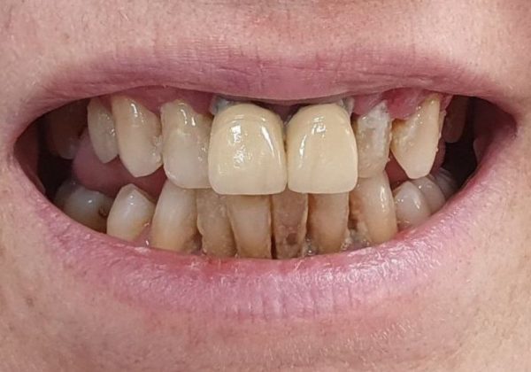 Antes: encía retraída, dientes amarillos y desgastados y espacios abiertos entre las piezas