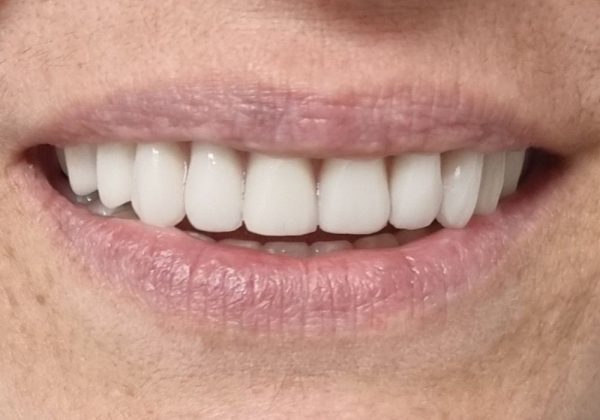 Despu&eacute;s: pr&oacute;tesis fija completa sobre implantes, con la enc&iacute;a sana alrededor