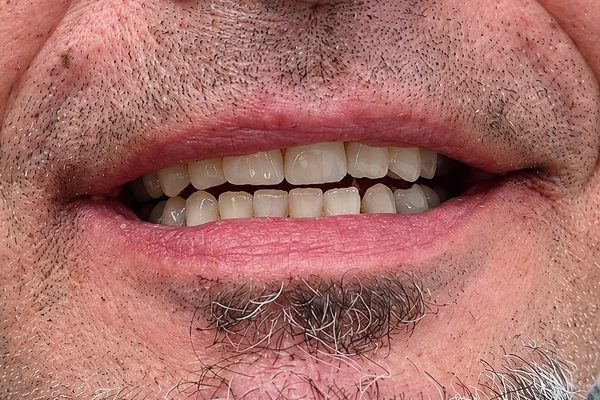 Despu&eacute;s: la arcada entera rehabilitada con pr&oacute;tesis fija sobre implantes