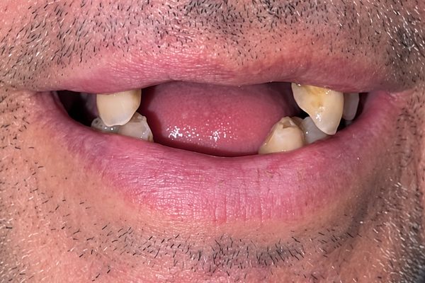 Antes: solo quedan unas piezas sueltas a los lados y entre ellas se ve la encía, sin dientes