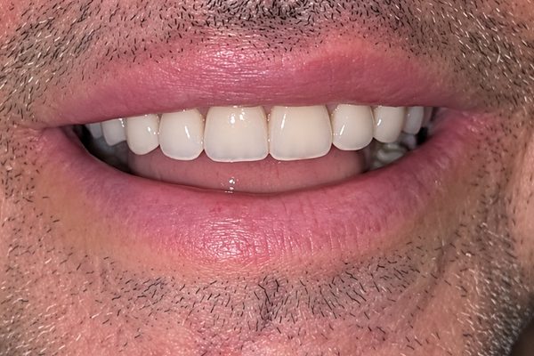 Despu&eacute;s: la arcada completa con pr&oacute;tesis fija sobre implantes